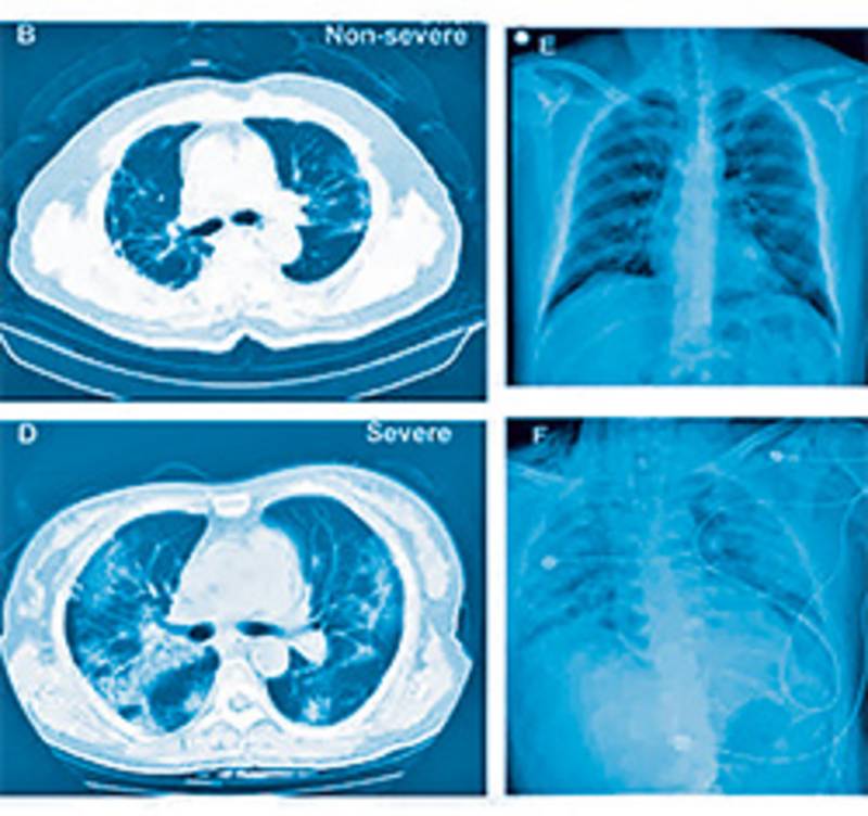 Thorax-CT: Ein leichter und ein schwerer Fall von COVID-19. Aus: Guan et al, NEJM 2020